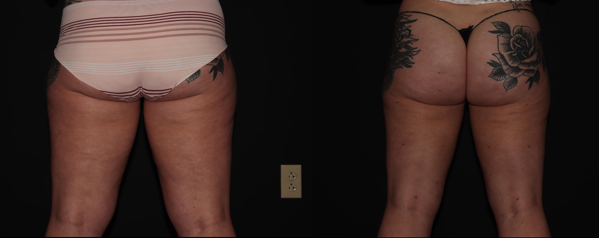 Before and After Image: Liposuction – Thighs - back